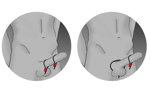 Elektrosex Penisringe ElectraLoops Prestige Red leitfähig m. Aluminium-Verbindung einstellbar von ELECTRASTIM kaufen