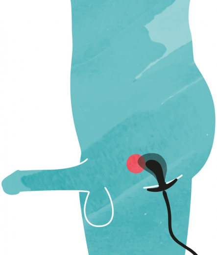 Postata Analplug aufblasbar m. abnehmbarem Schlauch Silikon